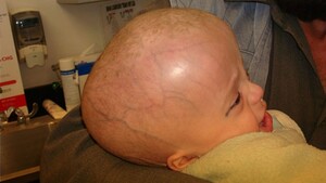 Hydrocephalus